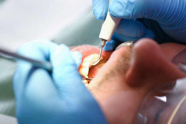 Best Emergency Root Canal Treatment in Cabin John, MD
