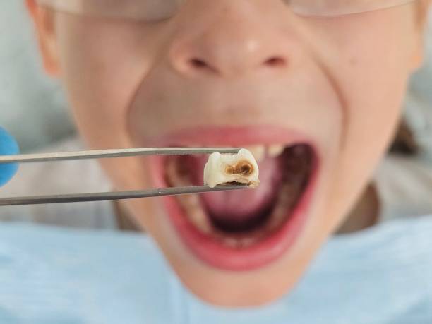 Best Emergency Root Canal Treatment in Cabin John, MD